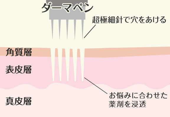 ダーマペンの効果とは?
