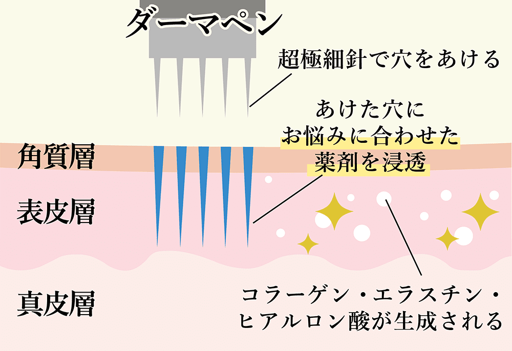 ダーマペンのメカニズム