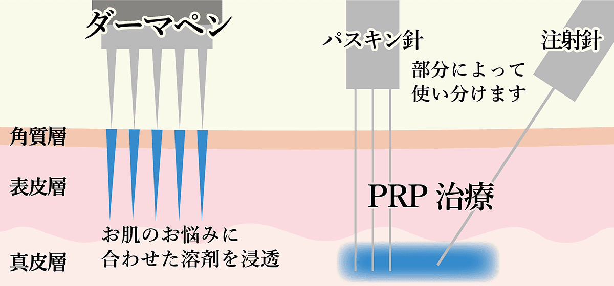 ダーマペン+PRP治療『ヴァンパイアプログラム』