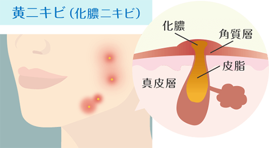 黄ニキビ（化膿ニキビ）