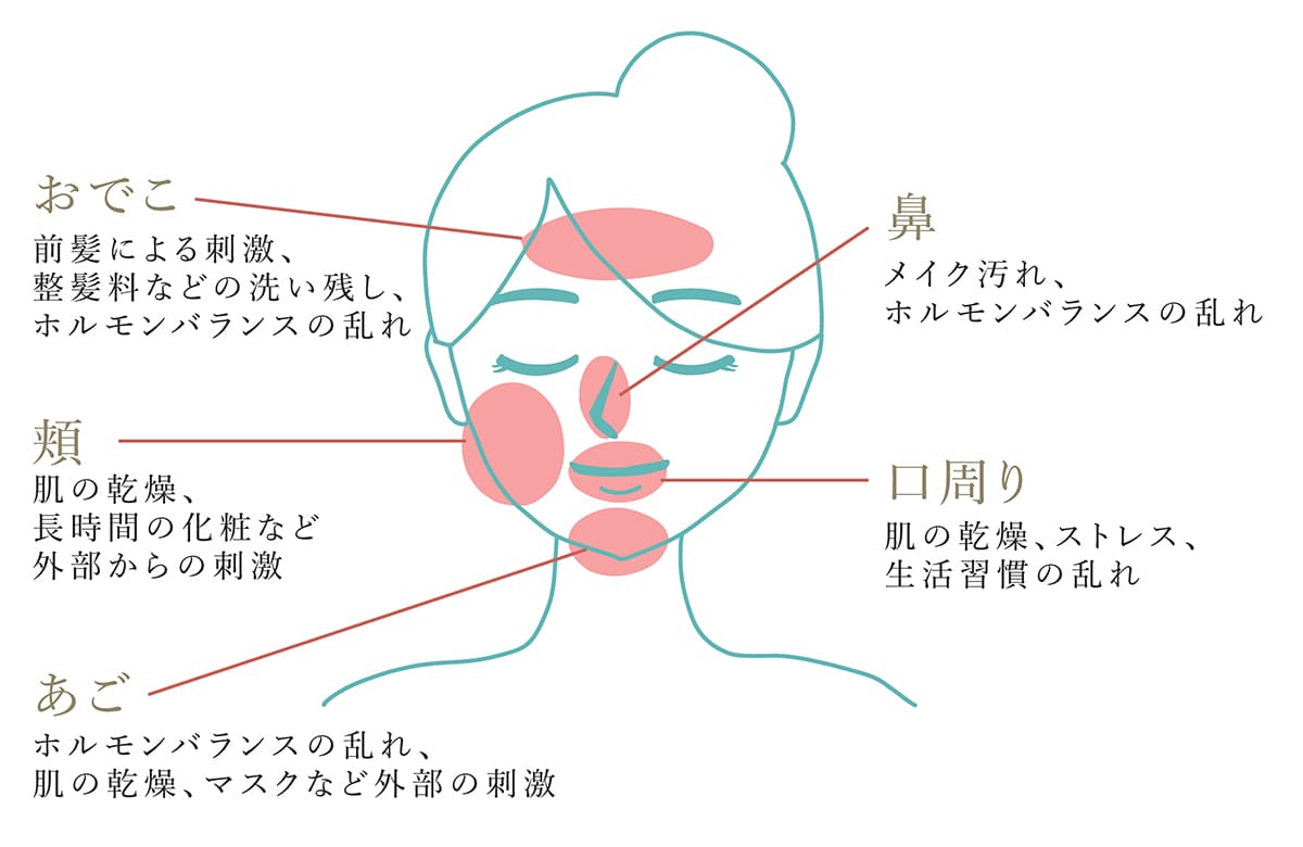 「場所」ごとに異なるニキビの対策方法