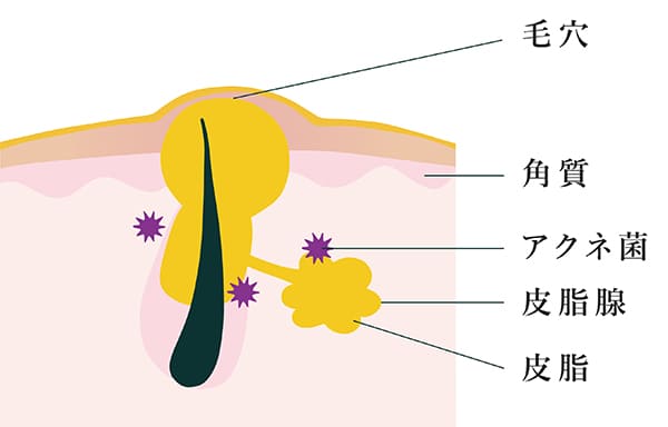 皮脂の過剰分泌を起こしている毛穴の断面図