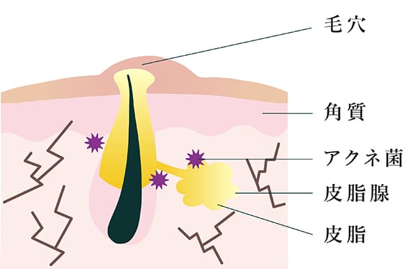 お肌の「角化」による毛穴詰まりを起こしている毛穴の断面図