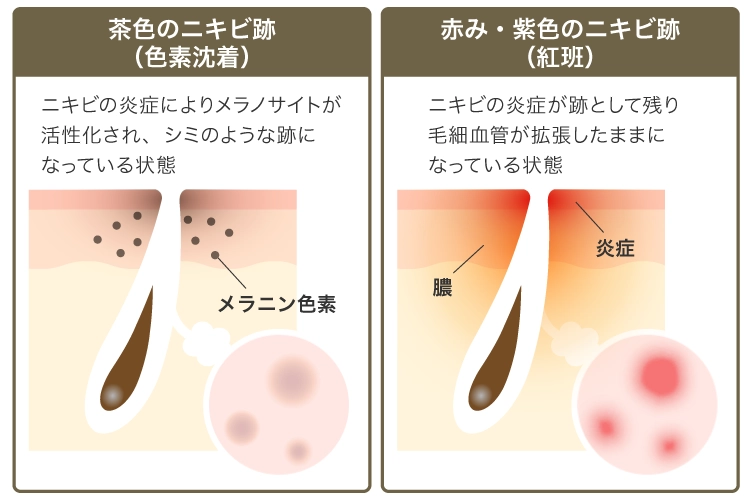 ニキビの種類別色素沈着の原因と症状