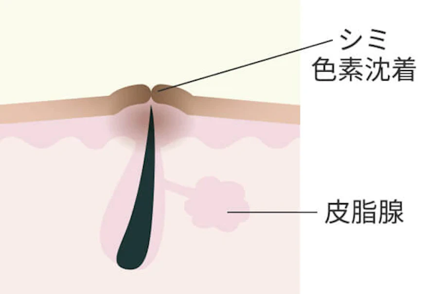 色素沈着のあるニキビ跡