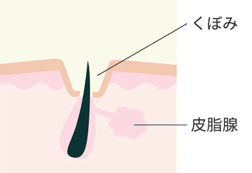 凹みのあるニキビ跡