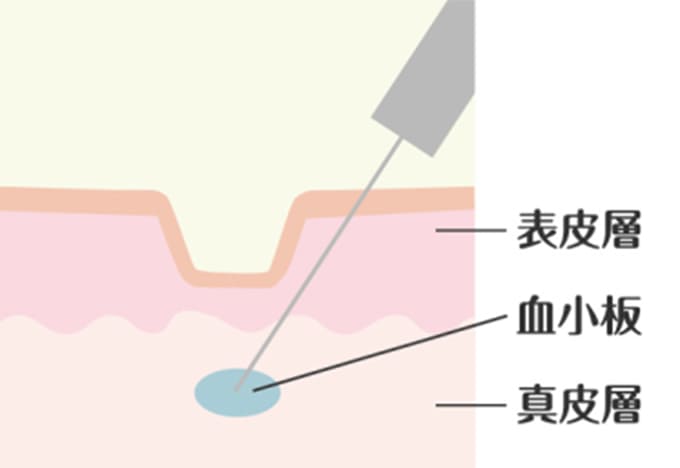 血小板を注入している皮膚の断面図