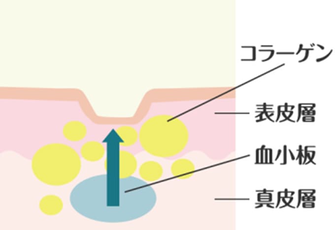 成長因子によりコラーゲンが増幅している皮膚の断面図