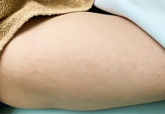 施術1週間後