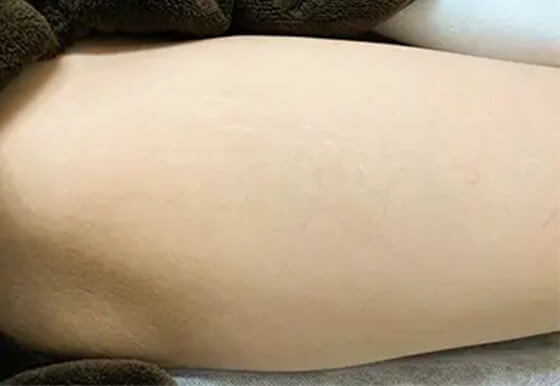 施術1ヶ月後