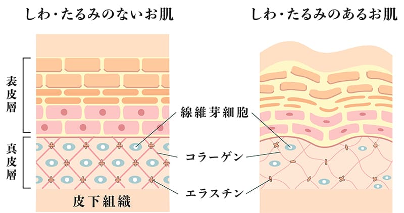 しわ・たるみのある肌とない肌の比較断面図