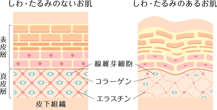 しわ・たるみのある肌とない肌の比較断面図