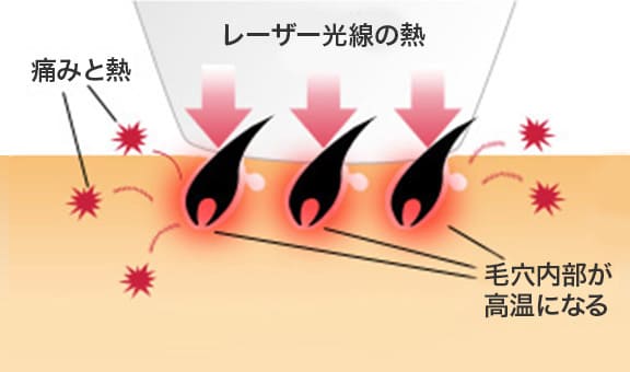 レーザーが「黒色のメラニン色素」に反応する