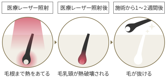 医療脱毛の仕組み