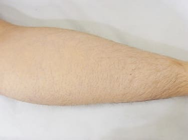 施術前