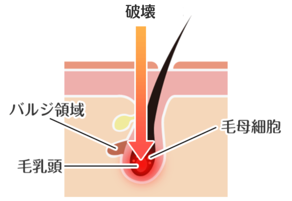 医療脱毛の仕組み