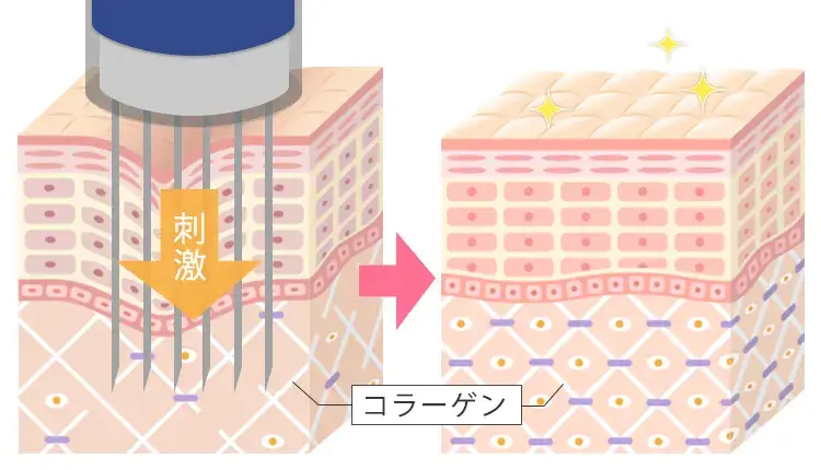 ダーマペンの基本的な仕組み