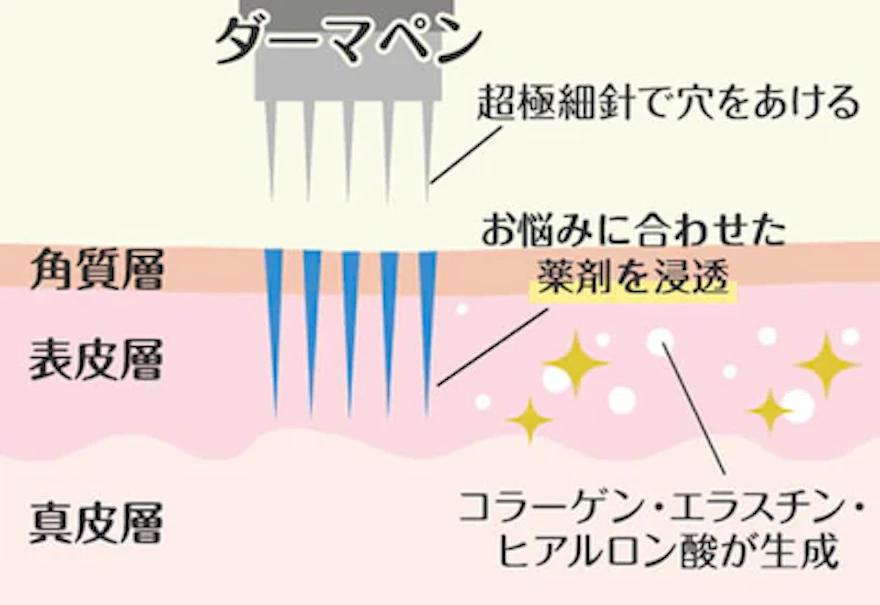 ダーマペンの効果