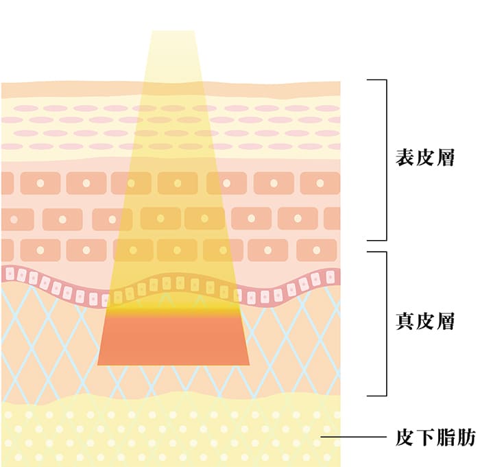 フラクショナルRF治療