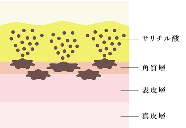 サリチル酸マクロゴールの肌への効果