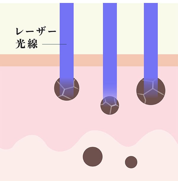 メラニンがレーザーに分解されている肌の断面図