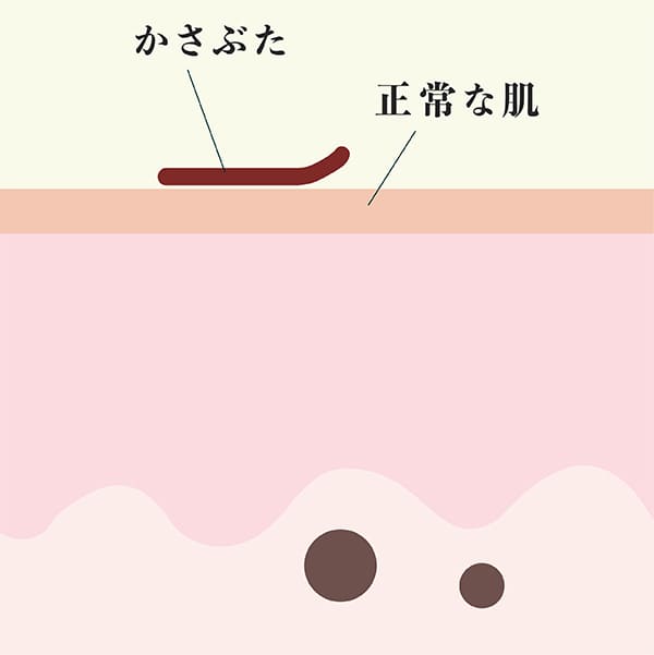 分解されたメラニンがかさぶたになっている肌の断面図