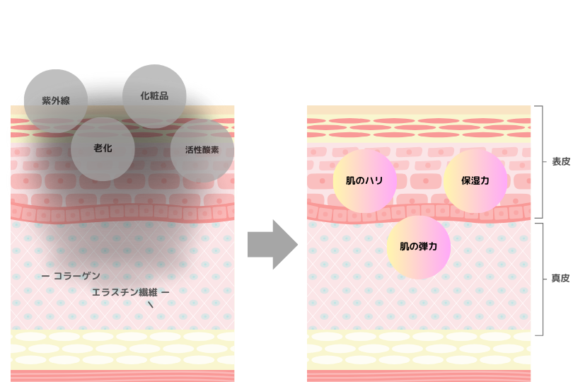 ニキビは進行に合わせて4つに分けられる
