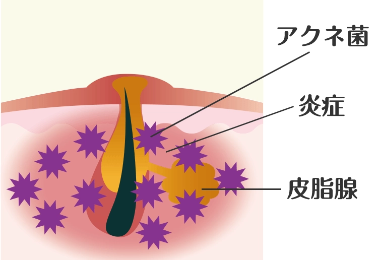 黄ニキビ