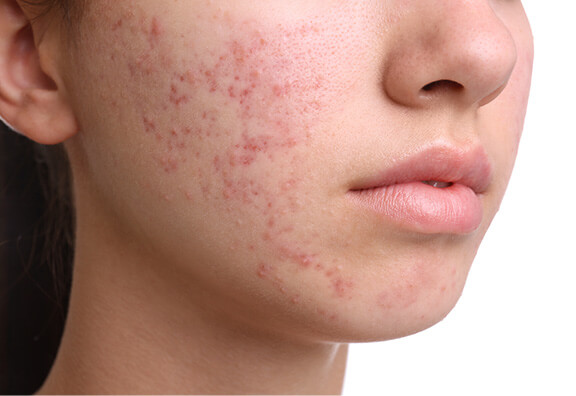 ニキビ・ニキビ跡