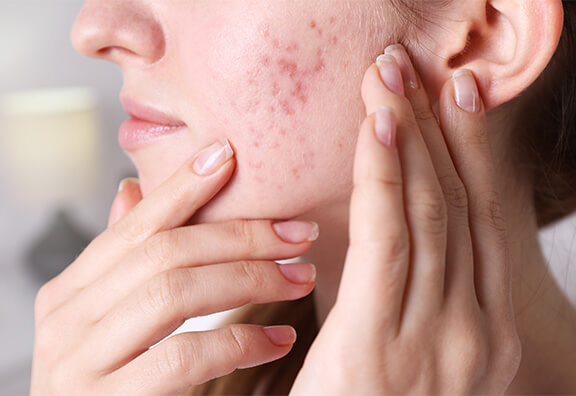 ニキビ跡の赤み・色素沈着