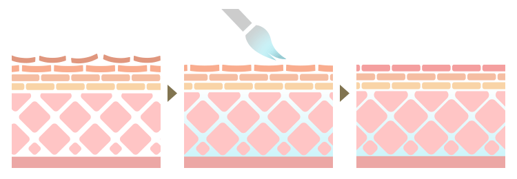 ケミカルピーリングとは