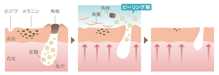 ピーリングによるニキビの改善