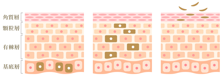 ピーリングによるシミの改善