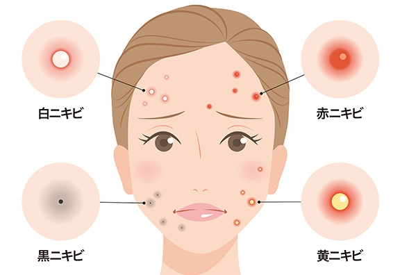 繰り返すニキビの改善