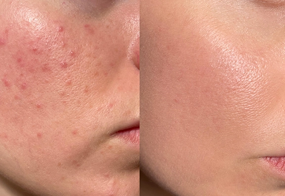 ニキビ跡の赤み