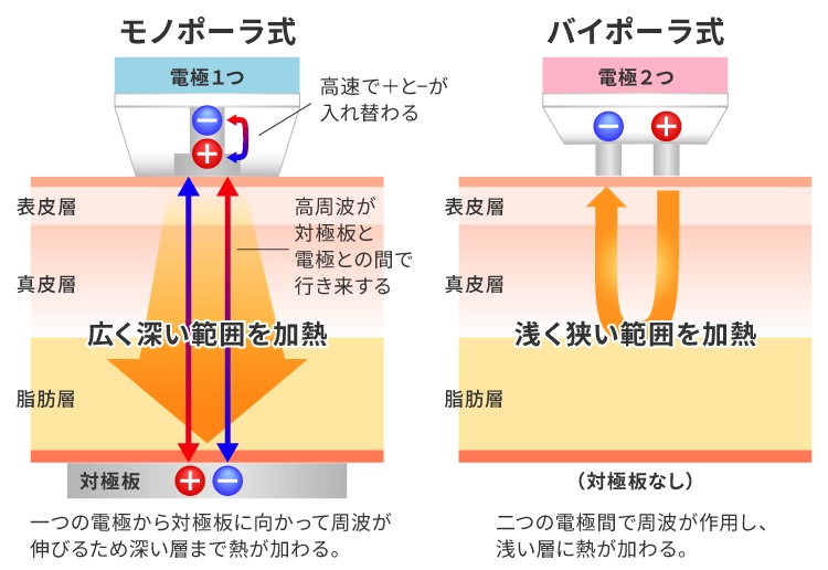 モノポーラ式とバイポーラ式