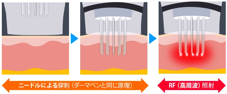 サーマニードルEVOとは