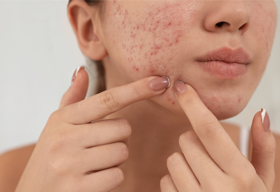 改善しにくいクレーターにはサブシジョン