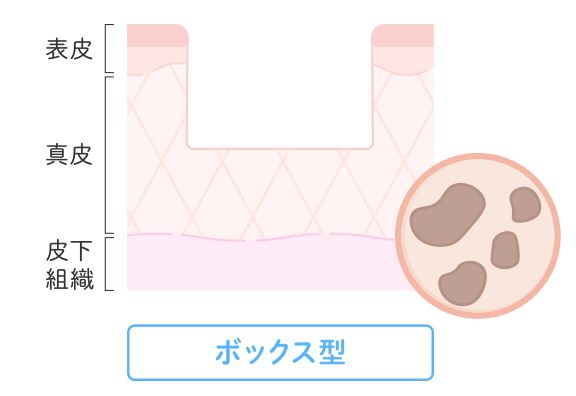 ボックスカー型