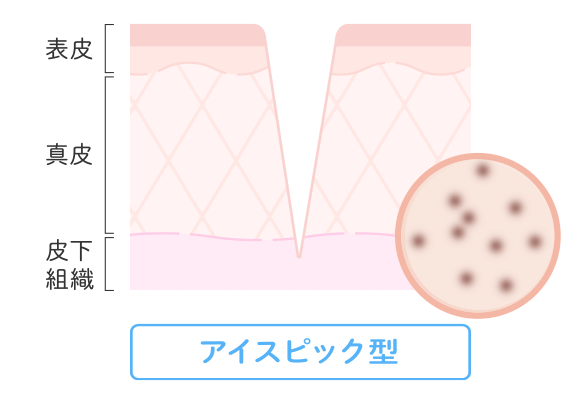 アイスピック型