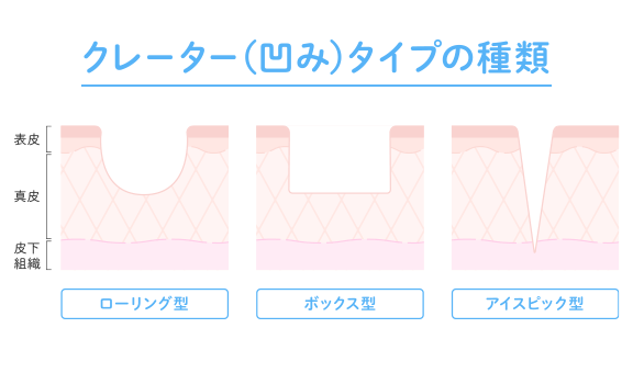 ニキビ跡のクレーター治療