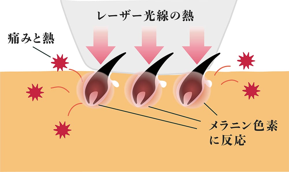 レーザーの熱がメラニン色素に反応する様子