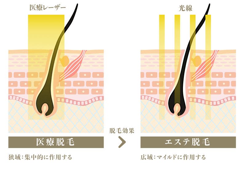 医療脱毛とエステ脱毛の、比較毛根断面図