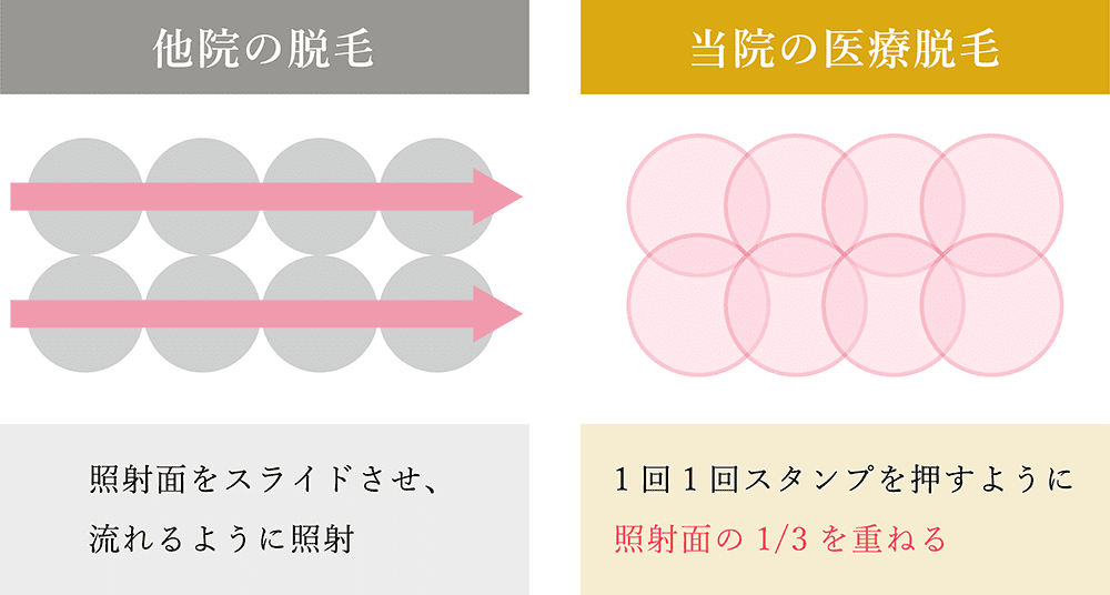 フェミークリニックと他院の、レーザー照射方法の比較イラスト