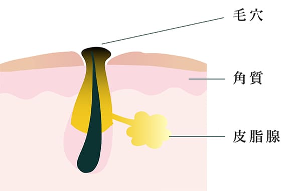 黒ニキビ解説