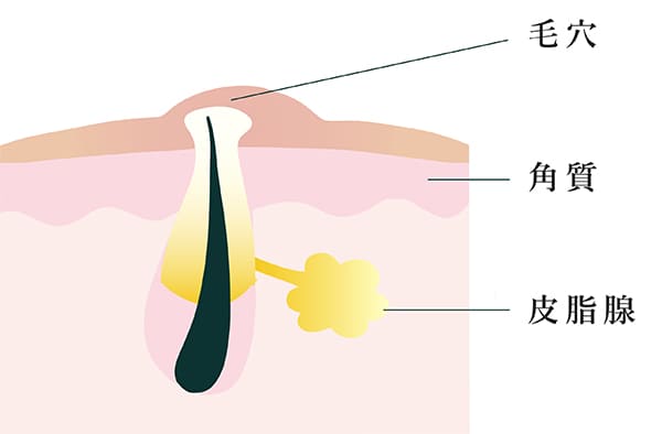 白ニキビ解説