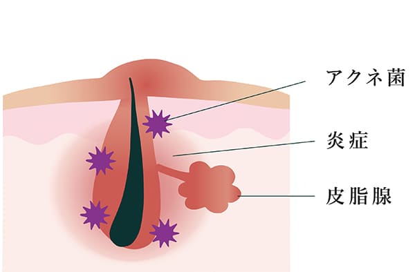 赤ニキビ解説