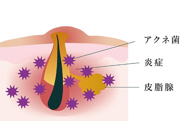 アクネ菌により炎症を起こしている皮膚の断面図