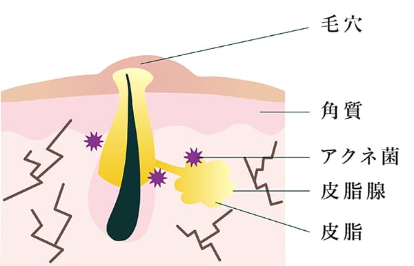 大人ニキビの肌状態