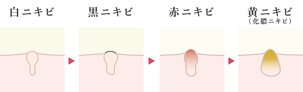 ニキビの種類とニキビの進行度合